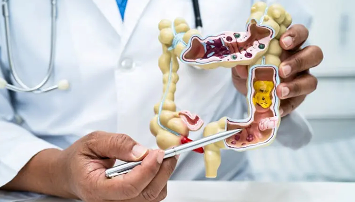 Colorectal cancer rates rising among younger generation – Study